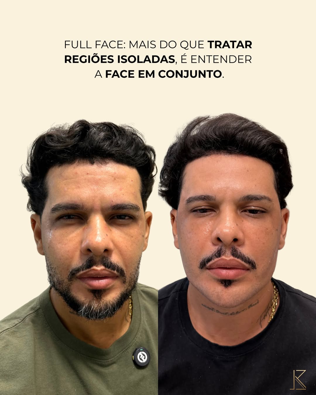 Antes e depois de harmonização facial masculina — definição mandibular em Salvador, BA