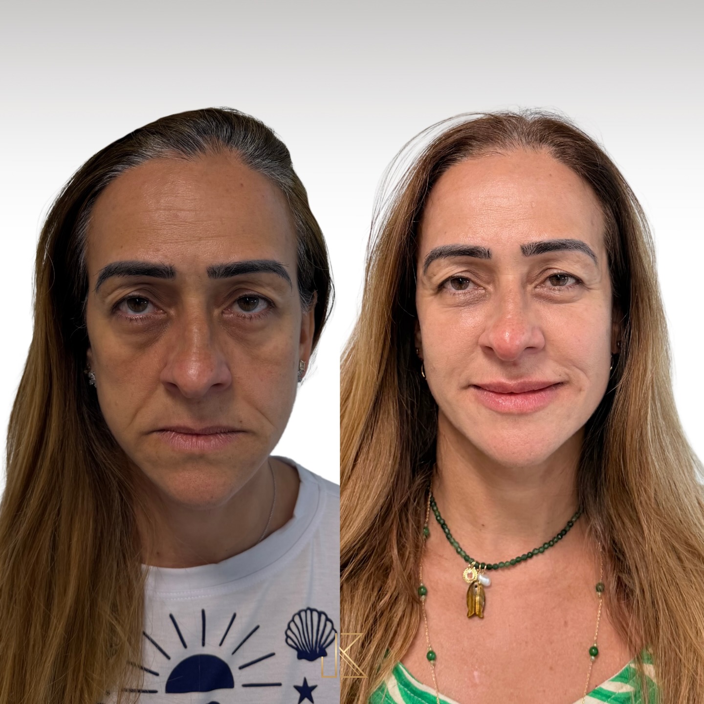 Rejuvenescimento Full Face — resultado de harmonização orofacial com a Dra. Joelane Bittencourt em Salvador, BA