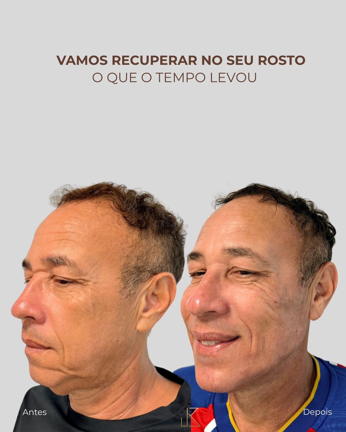 Rejuvenescimento Masculino — resultado de harmonização orofacial com a Dra. Joelane Bittencourt em Salvador, BA