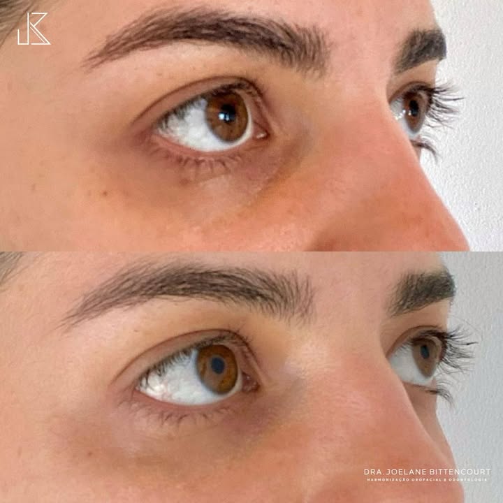 Preenchimento de Olheiras — resultado de harmonização orofacial com a Dra. Joelane Bittencourt em Salvador, BA