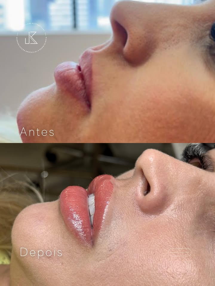 Lábios — Antes e Depois — resultado de harmonização orofacial com a Dra. Joelane Bittencourt em Salvador, BA