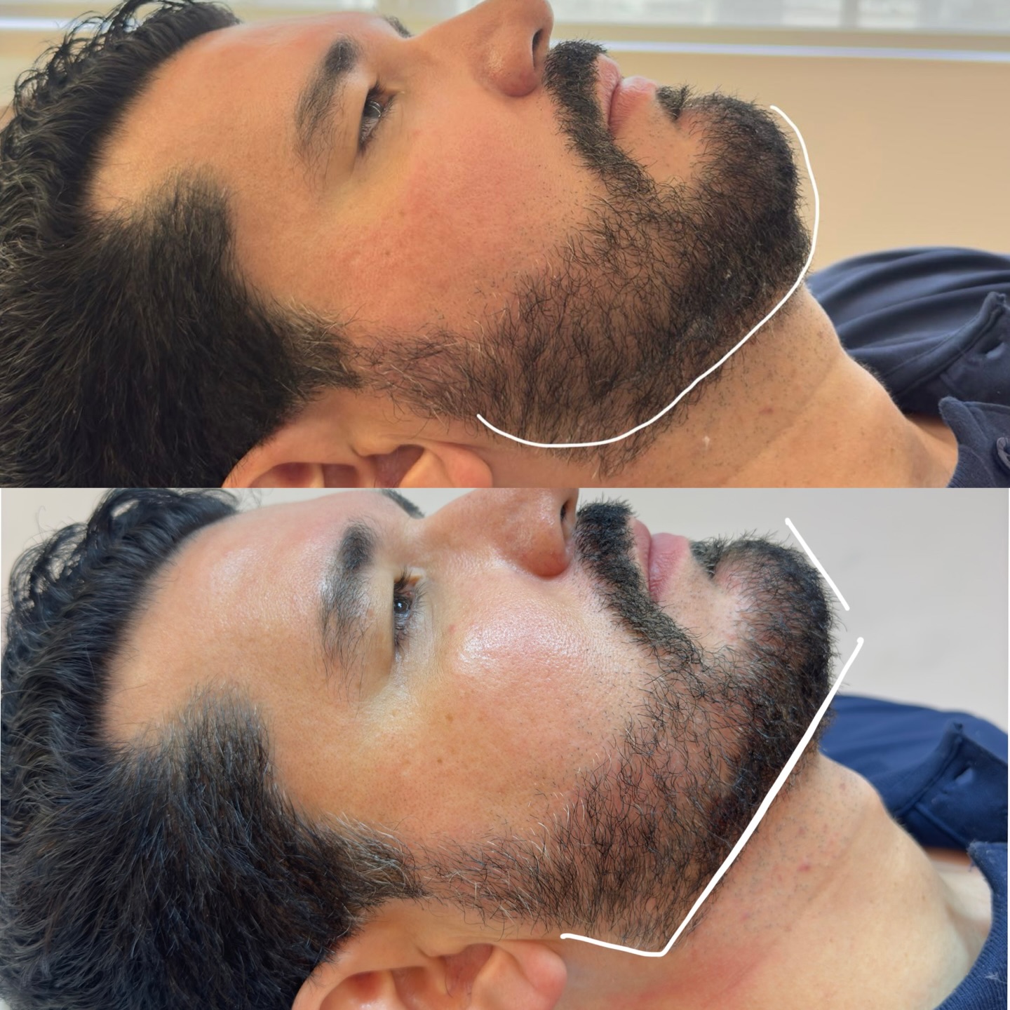 Definição Mandibular — resultado de harmonização orofacial com a Dra. Joelane Bittencourt em Salvador, BA