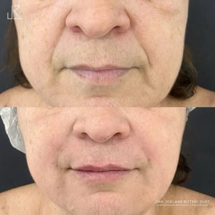 Correção do Bigode Chinês — resultado de harmonização orofacial com a Dra. Joelane Bittencourt em Salvador, BA