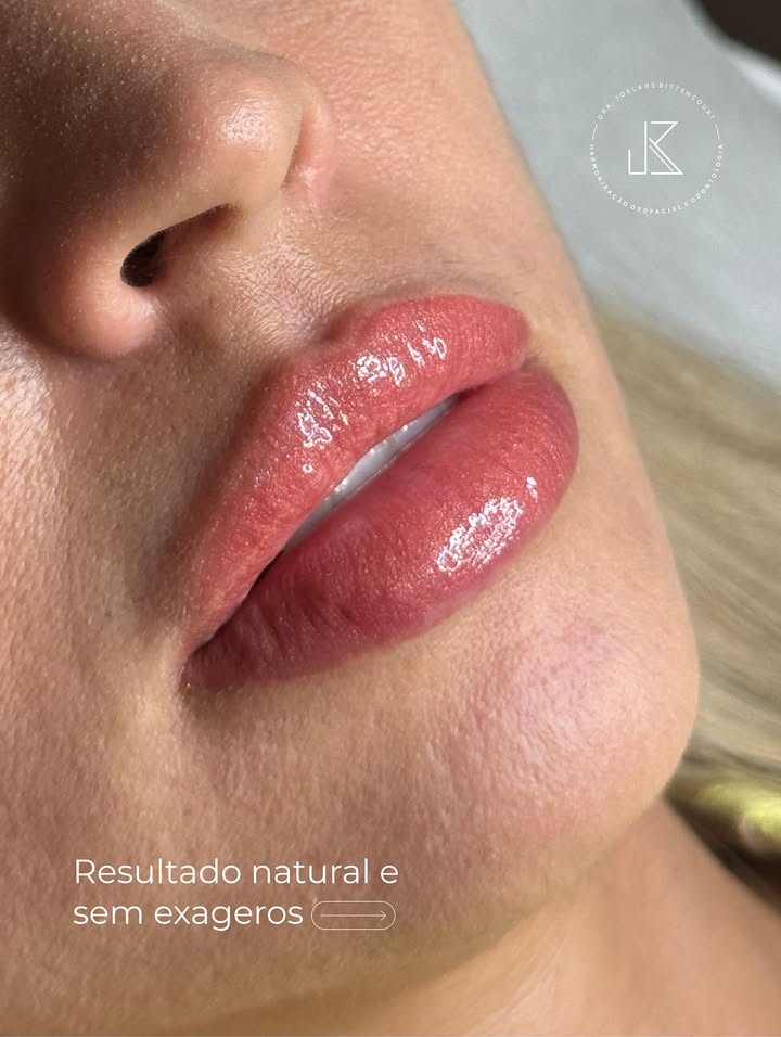 Preenchimento Labial — resultado de harmonização orofacial com a Dra. Joelane Bittencourt em Salvador, BA